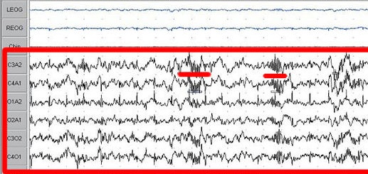 Datei:800px-Sleep EEG Stage 2 crop.jpg